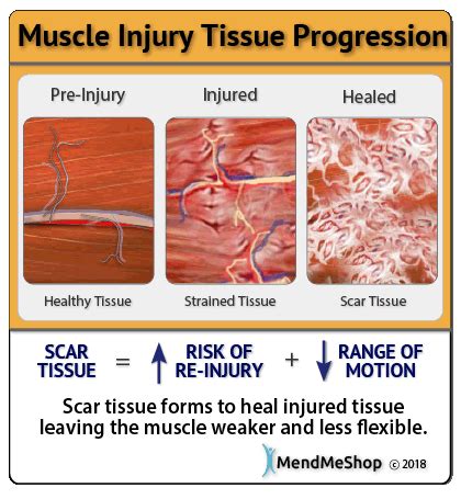 muscle strains before and after